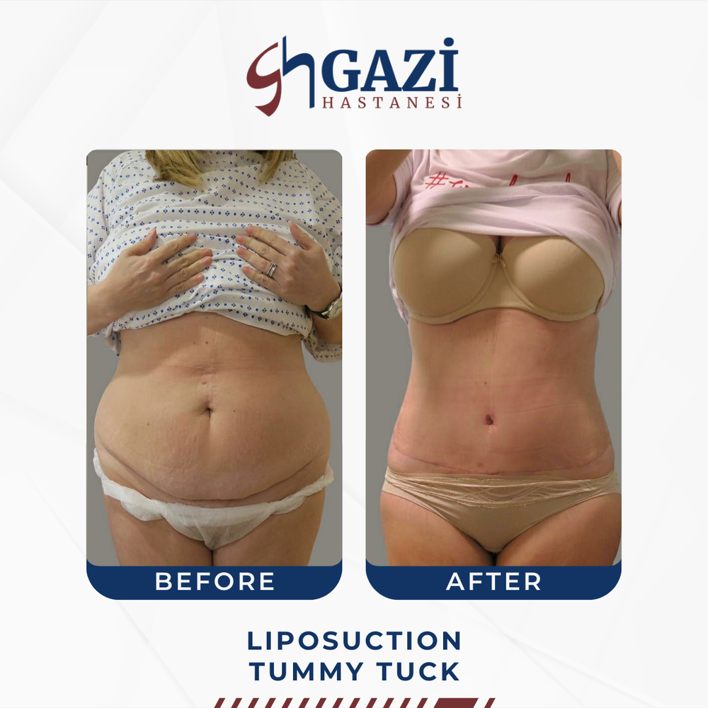 Before and After Result